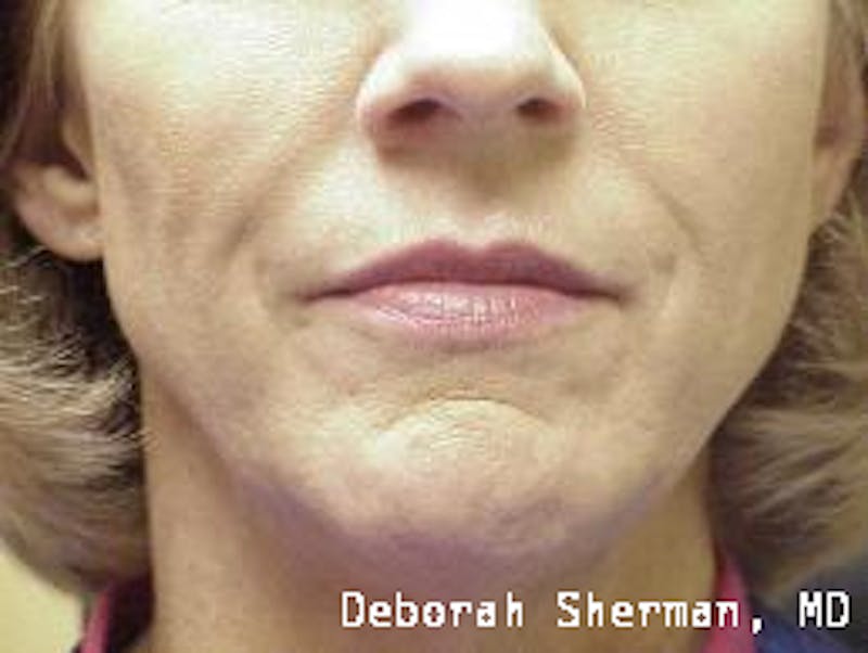 Facial Fillers Before & After Gallery - Patient 271067 - Image 3