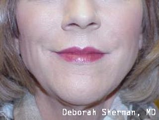 Facial Fillers Before & After Gallery - Patient 271067 - Image 4