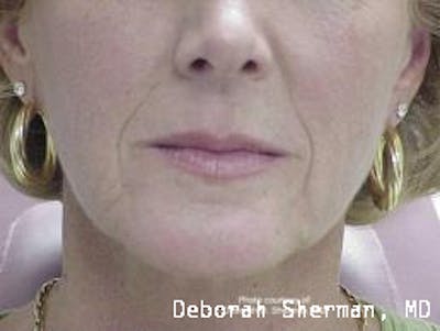 Facial Fillers Before & After Gallery - Patient 314167 - Image 1