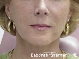 Facial Fillers Before & After Gallery - Patient 314167 - Image 2