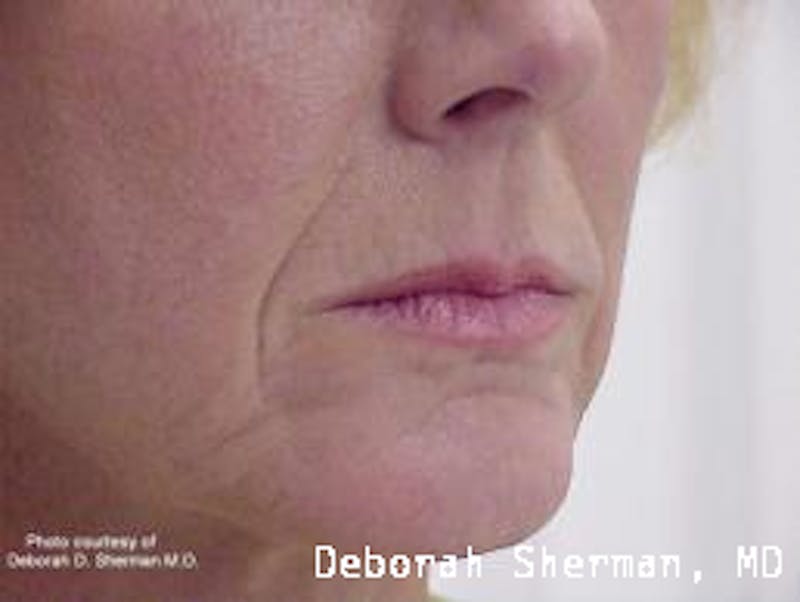 Facial Fillers Before & After Gallery - Patient 314167 - Image 3