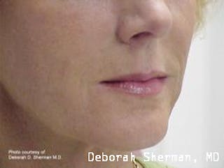 Facial Fillers Before & After Gallery - Patient 314167 - Image 4
