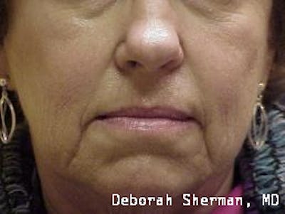 Facial Fillers Before & After Gallery - Patient 361258 - Image 1