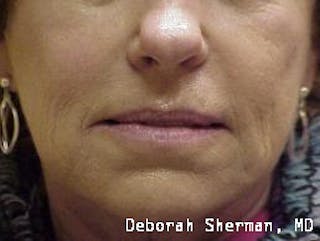 Facial Fillers Before & After Gallery - Patient 361258 - Image 2