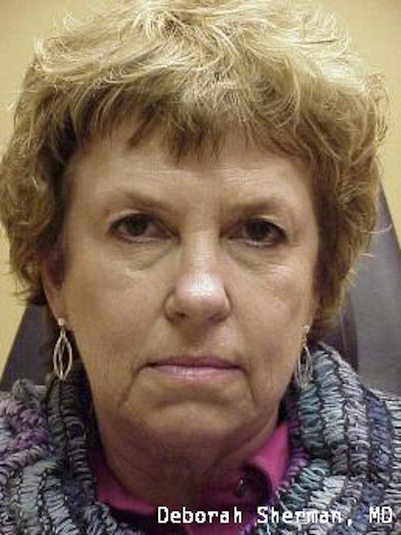 Facial Fillers Before & After Gallery - Patient 361258 - Image 3