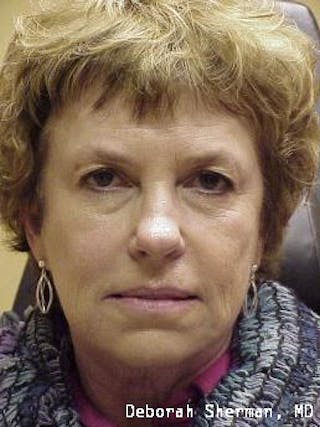 Facial Fillers Before & After Gallery - Patient 361258 - Image 4