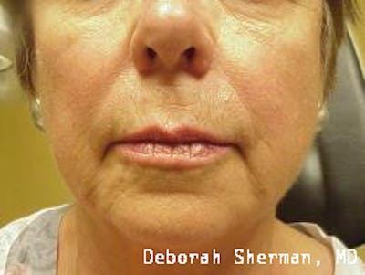 Facial Fillers Before & After Gallery - Patient 317816 - Image 1