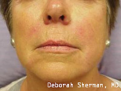 Facial Fillers Before & After Gallery - Patient 317816 - Image 2