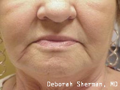 Facial Fillers Before & After Gallery - Patient 302752 - Image 1