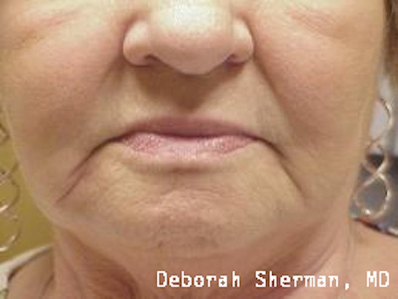 Facial Fillers Before & After Gallery - Patient 302752 - Image 1
