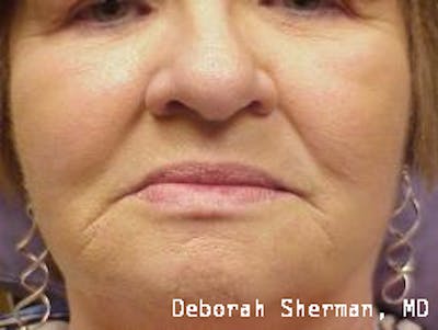 Facial Fillers Before & After Gallery - Patient 302752 - Image 2