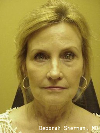 Facial Fillers Before & After Gallery - Patient 285978 - Image 1