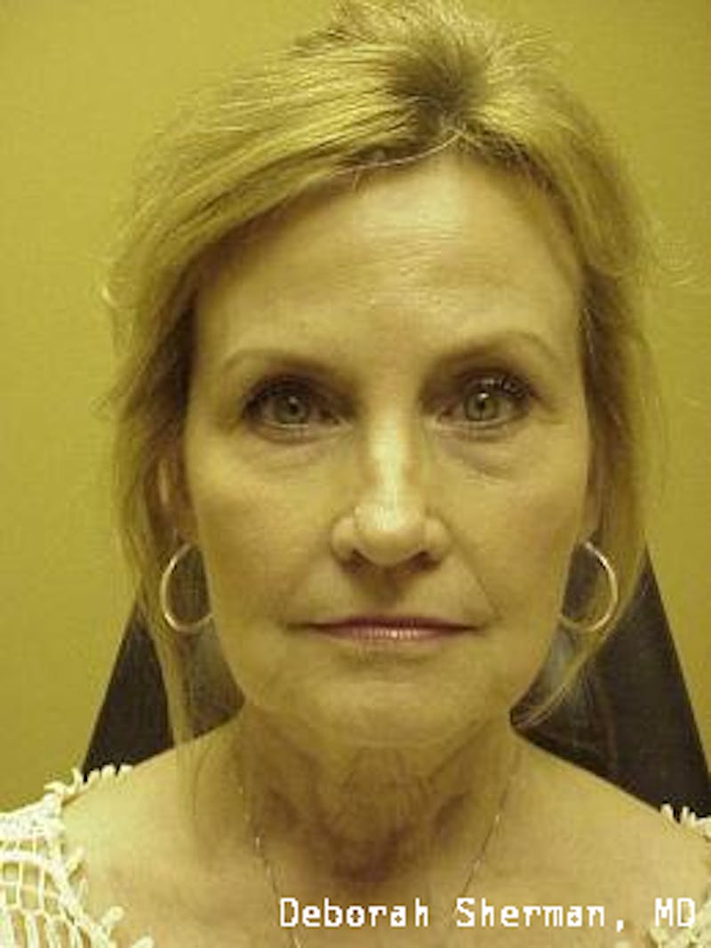Facial Fillers Before & After Gallery - Patient 285978 - Image 1