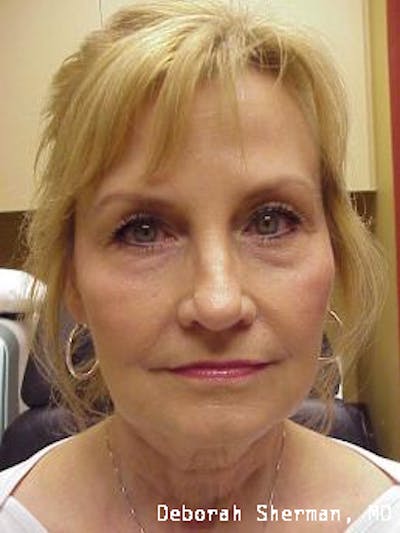Facial Fillers Before & After Gallery - Patient 285978 - Image 2