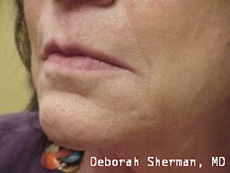 Facial Fillers Before & After Gallery - Patient 227932 - Image 3