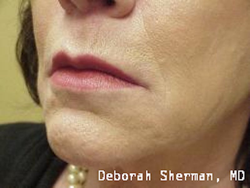 Facial Fillers Before & After Gallery - Patient 227932 - Image 4