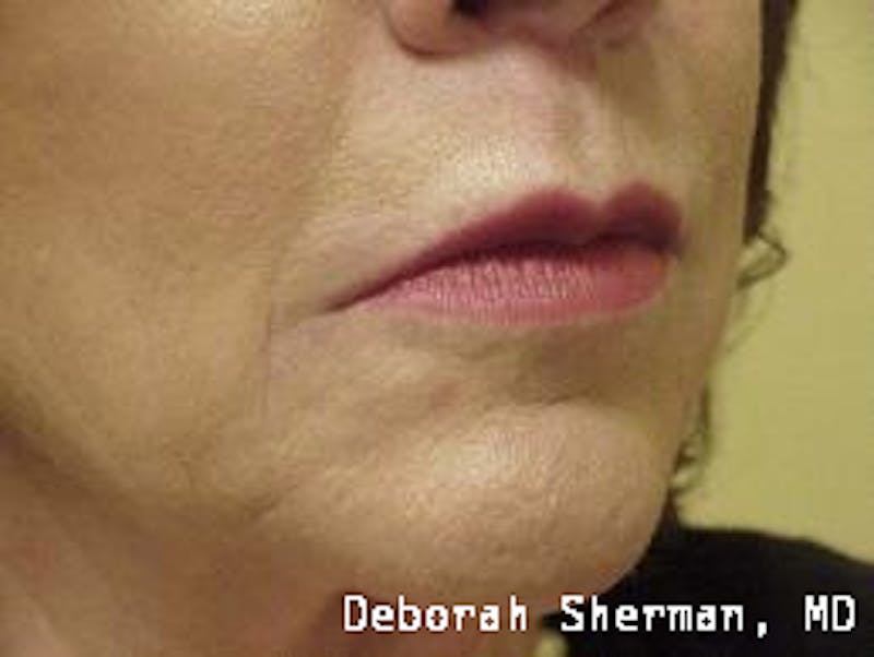 Facial Fillers Before & After Gallery - Patient 227932 - Image 6