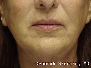 Facial Fillers Before & After Gallery - Patient 350453 - Image 2