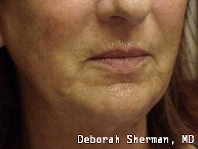 Facial Fillers Before & After Gallery - Patient 350453 - Image 3