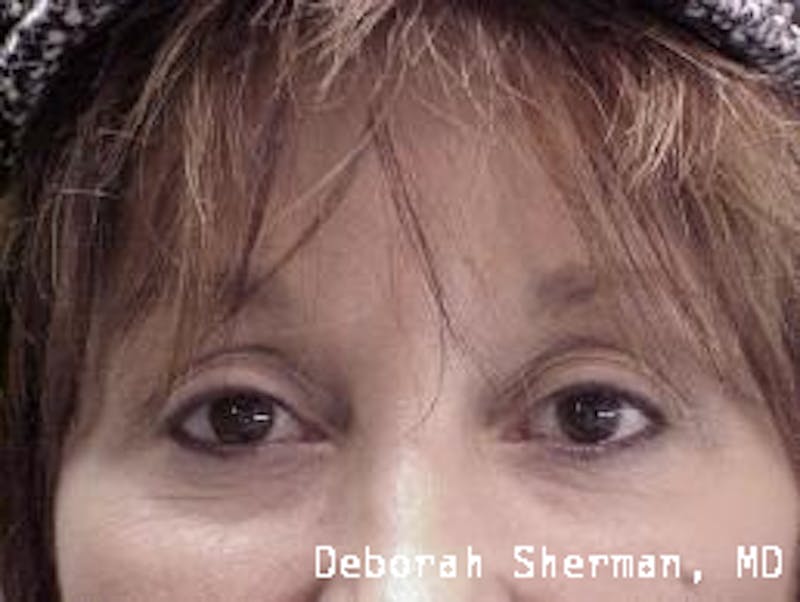 Permanent Makeup Before & After Gallery - Patient 226922 - Image 1