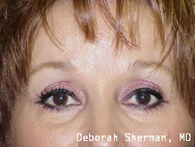 Permanent Makeup Before & After Gallery - Patient 226922 - Image 2