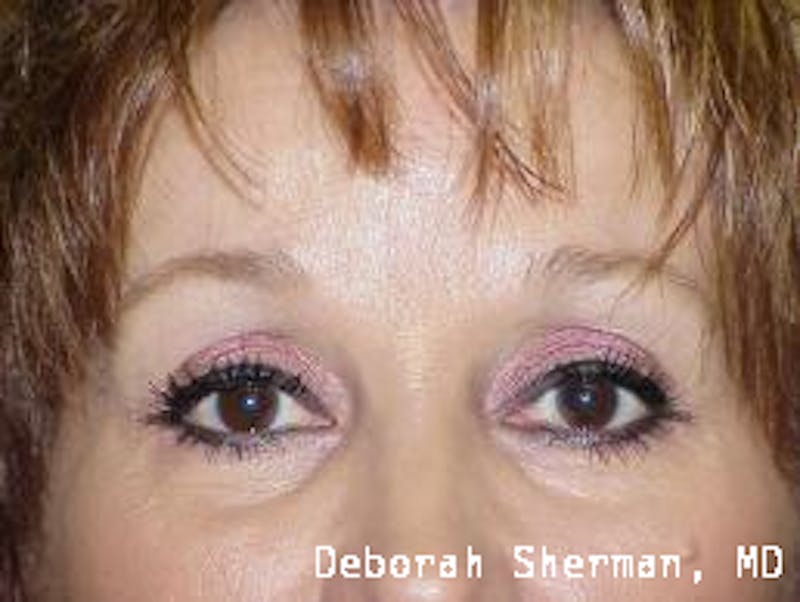 Permanent Makeup Before & After Gallery - Patient 226922 - Image 2