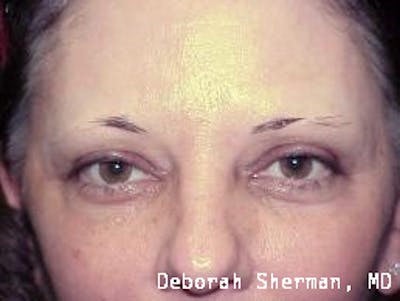 Permanent Makeup Before & After Gallery - Patient 329668 - Image 1