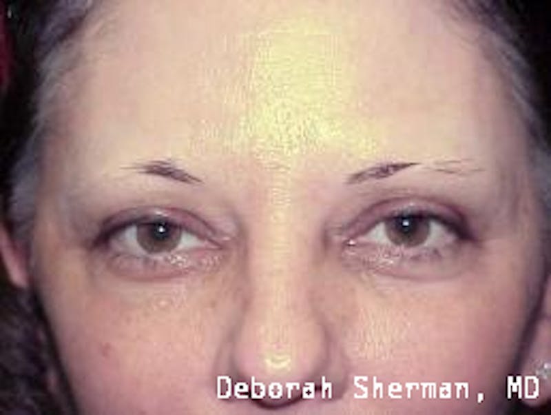 Permanent Makeup Before & After Gallery - Patient 329668 - Image 1