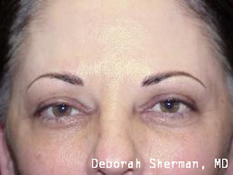Permanent Makeup Before & After Gallery - Patient 329668 - Image 2