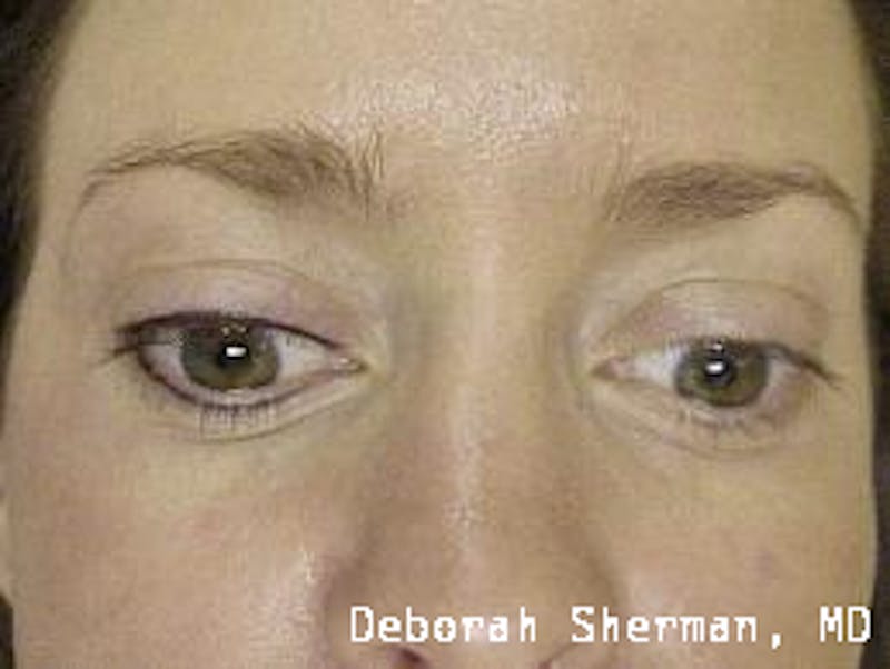 Permanent Makeup Before & After Gallery - Patient 155610 - Image 1