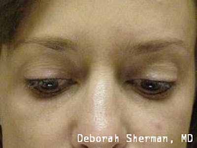 Permanent Makeup Before & After Gallery - Patient 155610 - Image 2