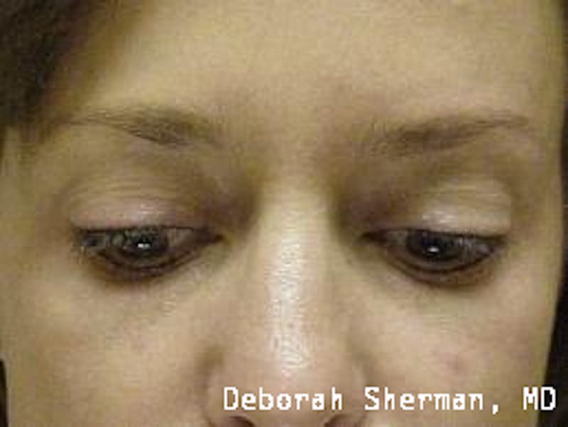 Permanent Makeup Before & After Gallery - Patient 155610 - Image 2
