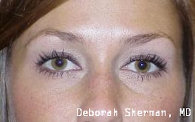 Latisse Before & After Gallery - Patient 178557 - Image 1