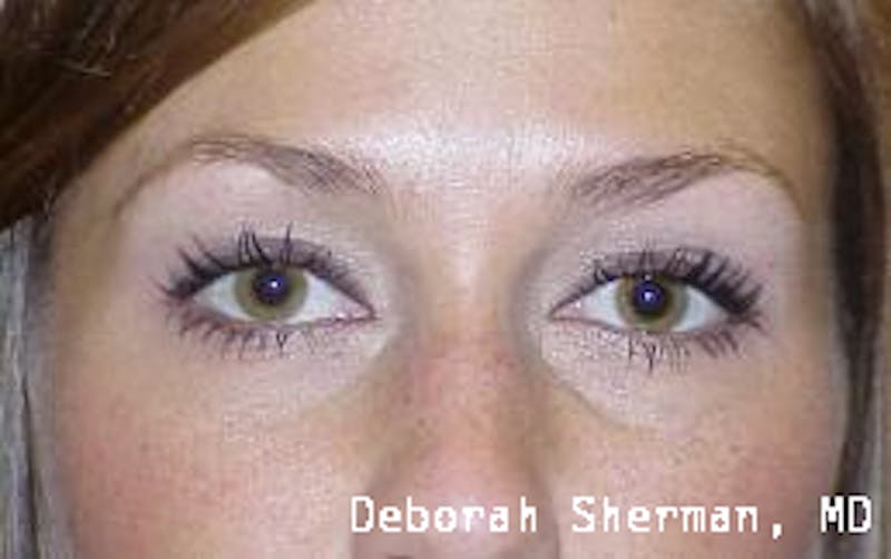 Latisse Before & After Gallery - Patient 178557 - Image 1