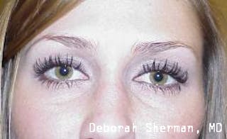 Latisse Before & After Gallery - Patient 178557 - Image 2