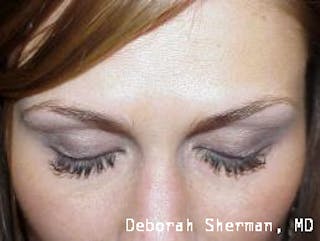 Latisse Before & After Gallery - Patient 178557 - Image 4