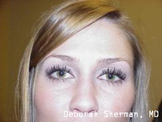 Latisse Before & After Gallery - Patient 178557 - Image 6