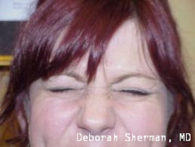 BOTOX Before & After Gallery - Patient 257414 - Image 1