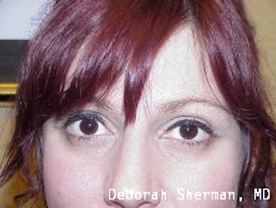 BOTOX Before & After Gallery - Patient 257414 - Image 2