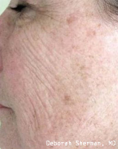 Chemical Peels Before & After Gallery - Patient 171717 - Image 1
