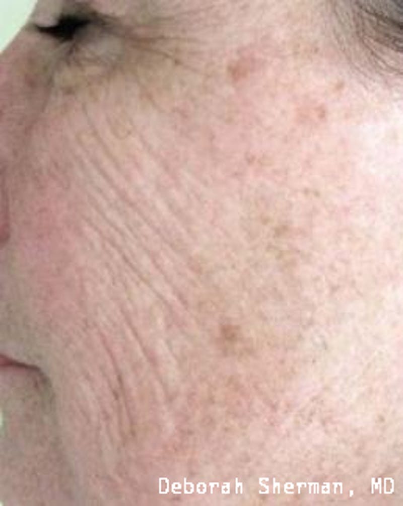 Chemical Peels Before & After Gallery - Patient 171717 - Image 1