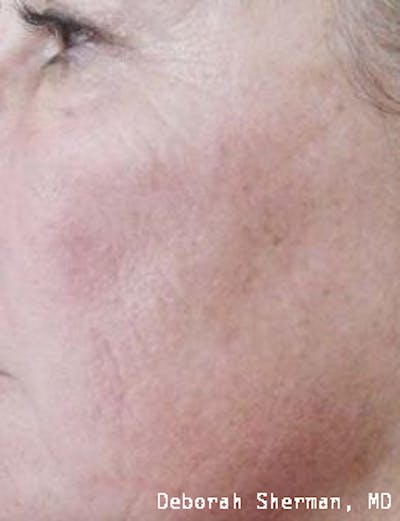 Chemical Peels Before & After Gallery - Patient 171717 - Image 2