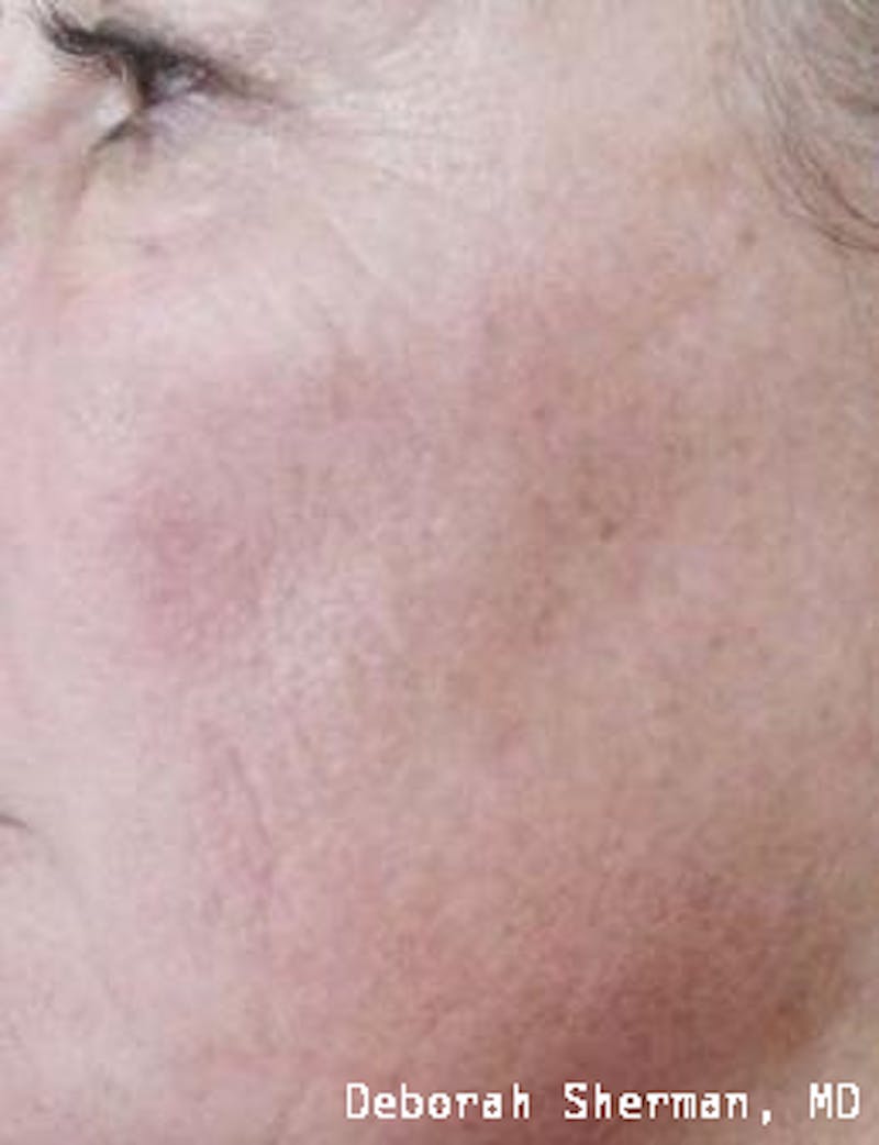 Chemical Peels Before & After Gallery - Patient 171717 - Image 2