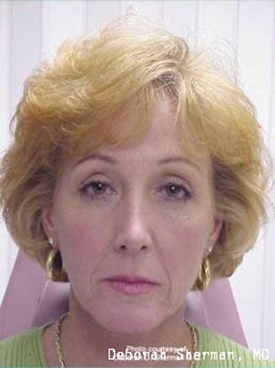 Liquid Lift Before & After Gallery - Patient 304549 - Image 1