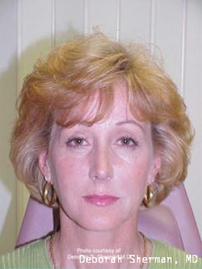 Liquid Lift Before & After Gallery - Patient 304549 - Image 2
