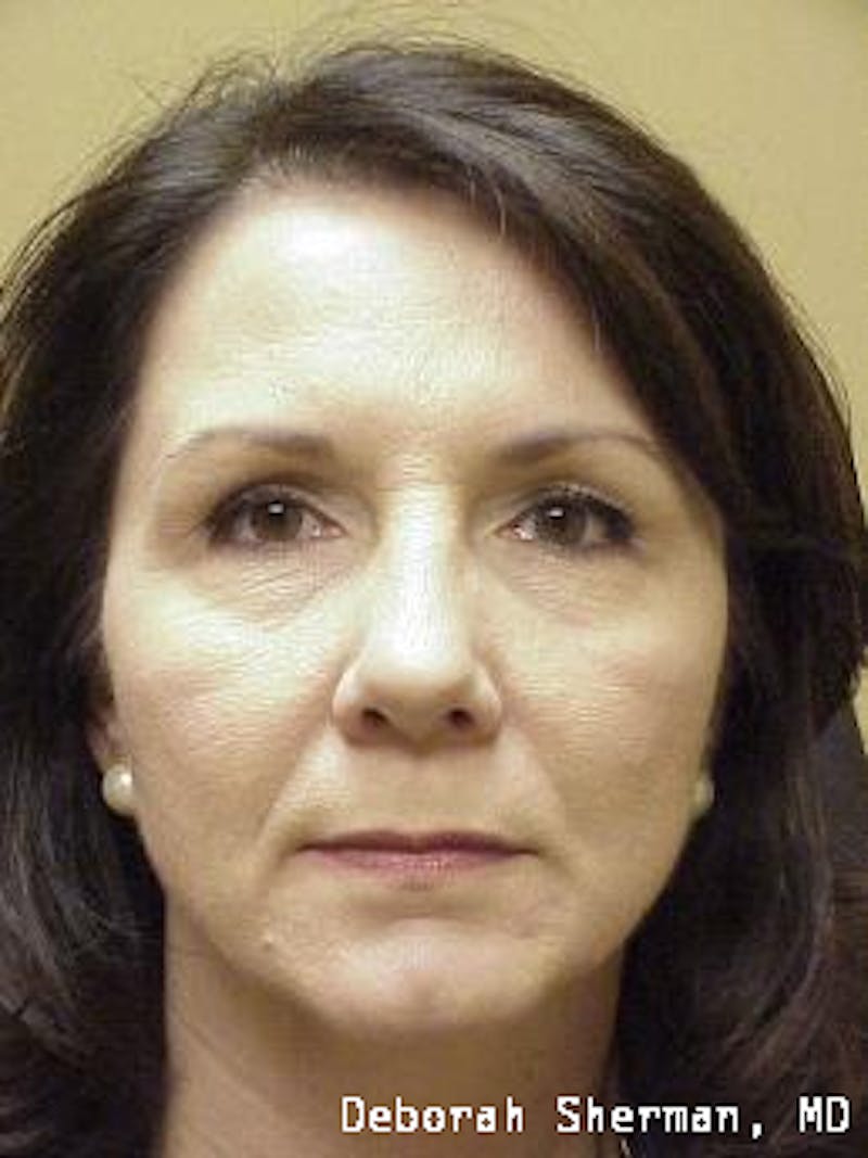 Restylane Silk Before & After Gallery - Patient 192299 - Image 1