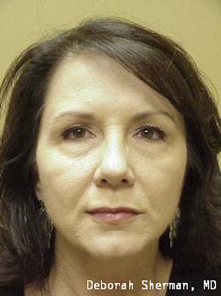 Restylane Silk Before & After Gallery - Patient 192299 - Image 2