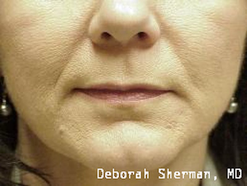 Restylane Silk Before & After Gallery - Patient 192299 - Image 3