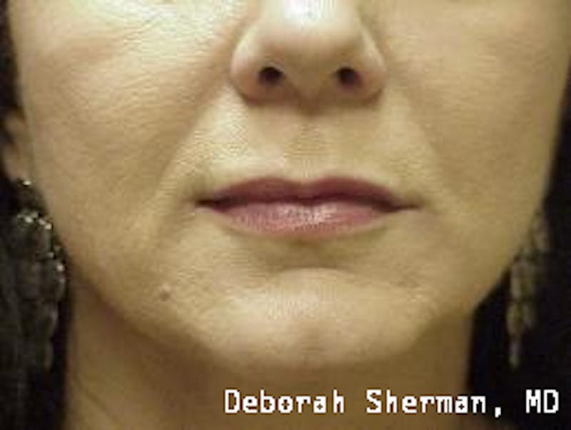Restylane Silk Before & After Gallery - Patient 192299 - Image 4