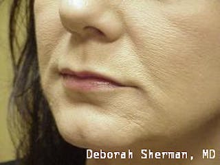 Restylane Silk Before & After Gallery - Patient 192299 - Image 6